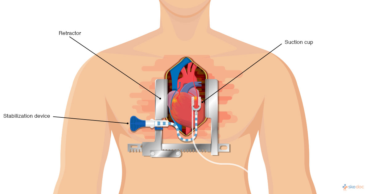 coronary artery bypass grafting (cabg)