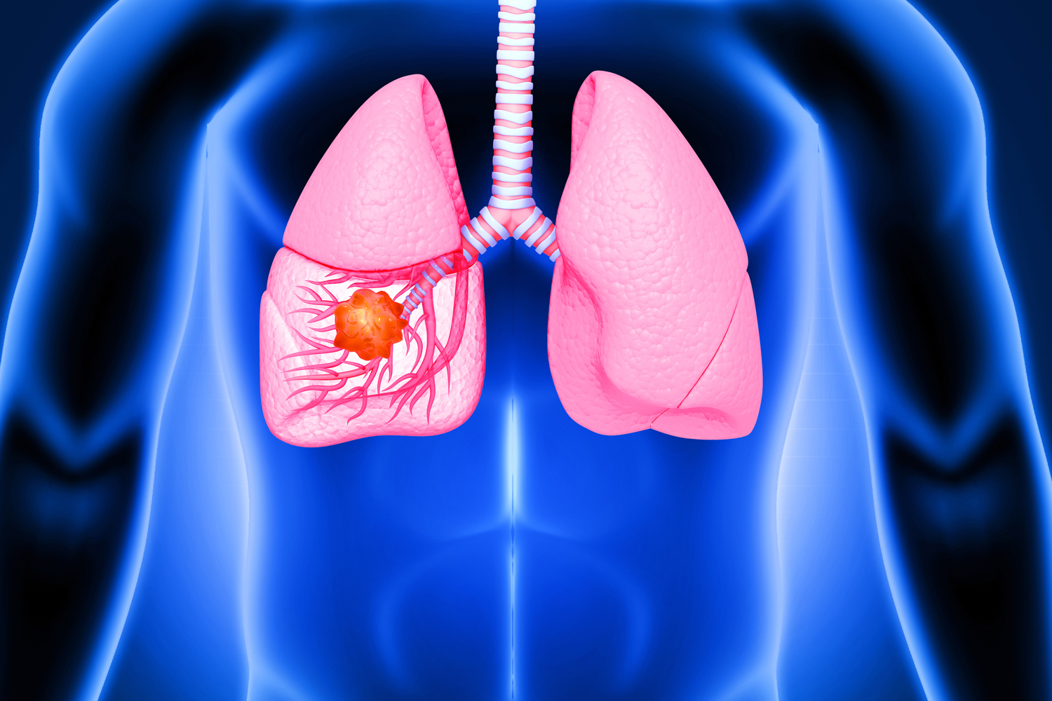 Heart Specialist in Indore - lung cancer surgery
