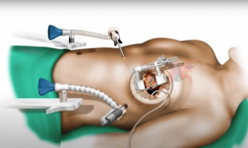 Heart Specialist in Indore - minimal invasive cardiac surgery